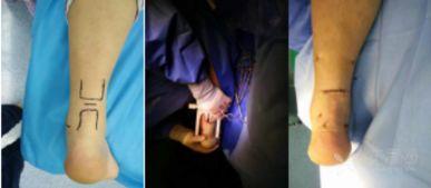 跟腱缝合术头条视频,揭秘手术过程及康复要点